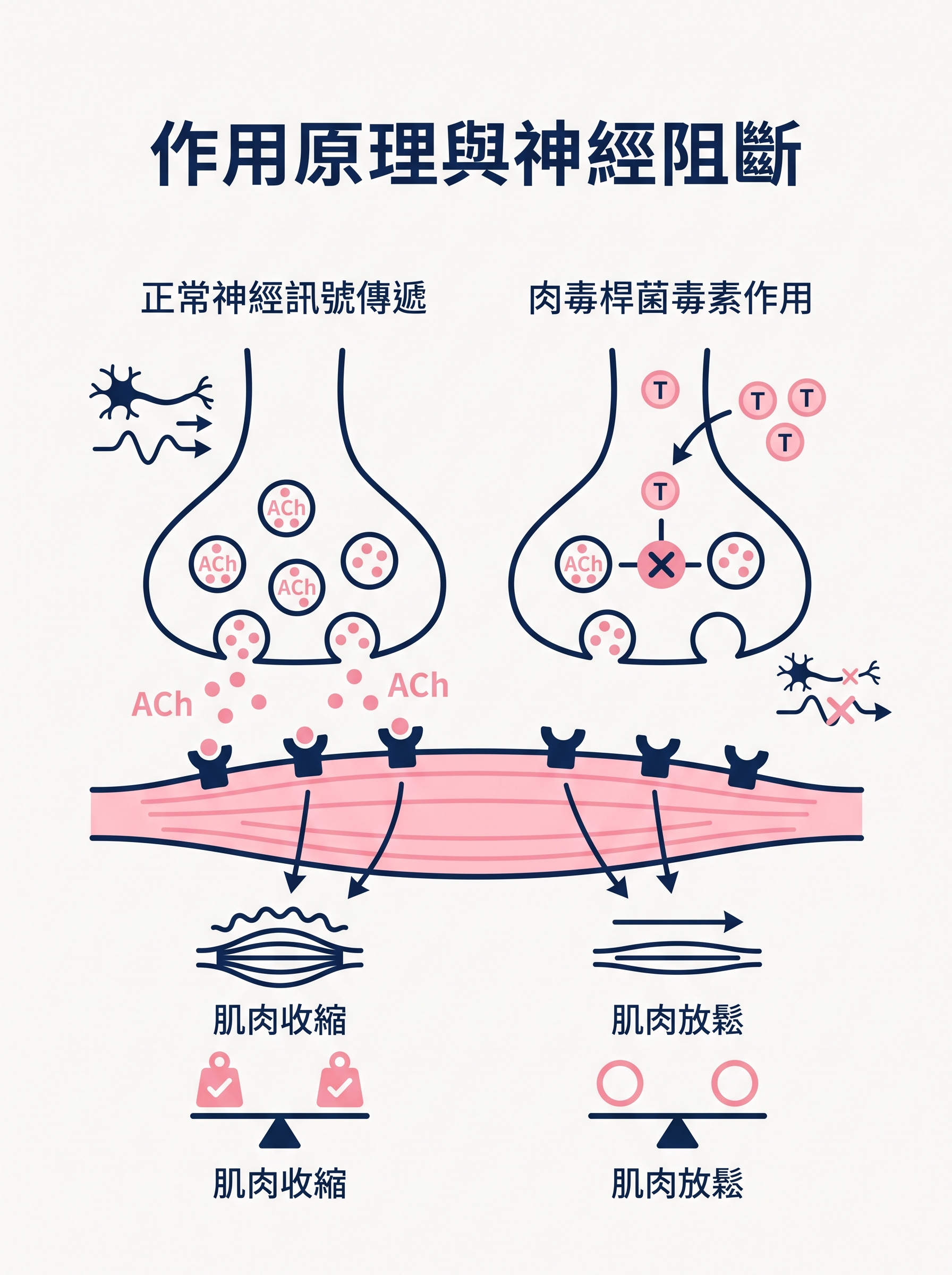 肉毒桿菌素注射全解析：除皺、縮肌、止汗的作用原理與注意事項